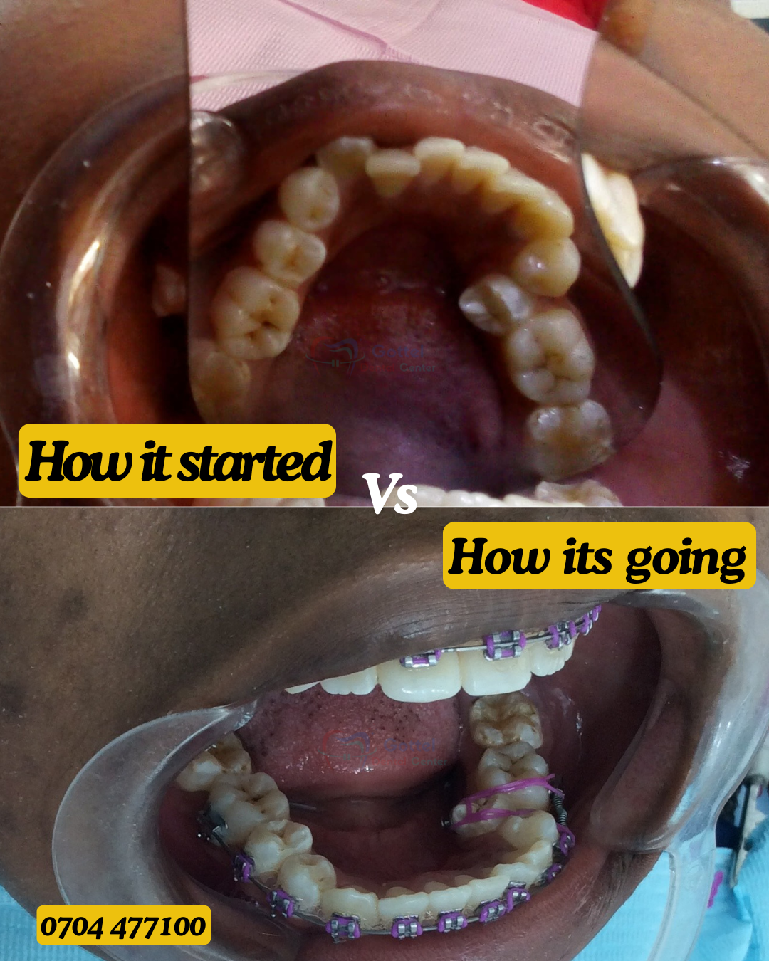 Braces transformation 5b